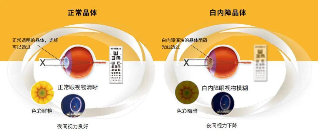 玻璃體混濁最新特效藥，突破與創新的治療策略